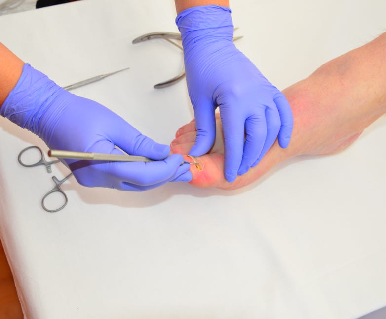 Patient being treated for ingrowing toenails by Feet For Purpose