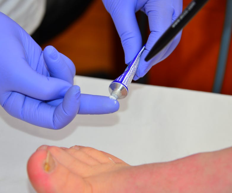 Feet For Purpose treating a patient with Athletes Foot. Home visit Podiatrist Chiropodist in Buckingham, Bicester, Aylesbury & Milton Keynes