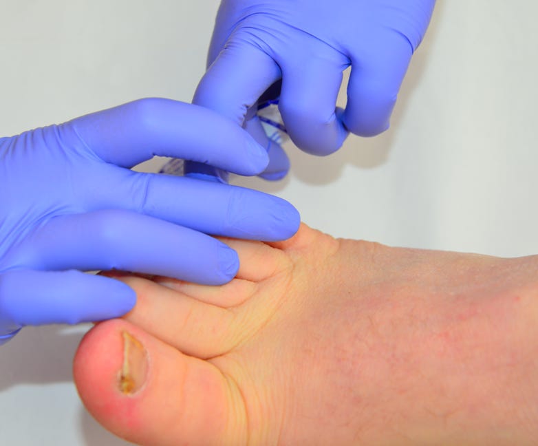 Patient with diabetes being treated by Feet For Purpose