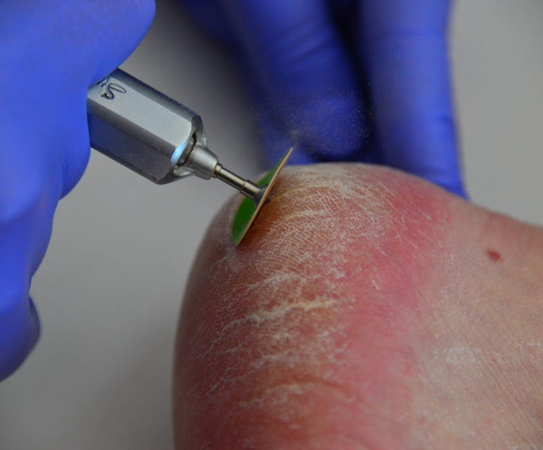Patient with dry skin being treated by Feet For Purpose