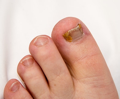Patient with fungal nail infection being treated by Feet For Purpose