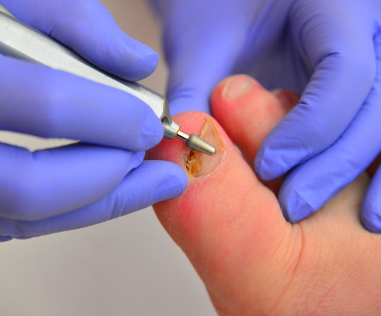 Patients with painful nails being treated by Feet For Purpose