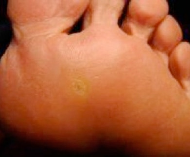 Patients being trated for corns by Feet For Purpose - home visit podiatrist